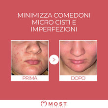 Carica l'immagine nel visualizzatore di Gallery, MOST - Glicosal Esfoliante Viso Micropeeling, Lozione con Acido Salicilico e Acido Glicolico - Delicata Azione Peeling V