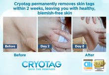 Carica l'immagine nel visualizzatore di Gallery, Cryotag Skin Tag Remover – Rimozione Rapida ed Efficace dei Fibromi Penduli – Rimuove i le Escrescenze della Pelle in un
