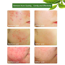 Carica l'immagine nel visualizzatore di Gallery, Olio di Albero del Tè,Tea Tree Essential Oil,Olio Di Tea Tree,Oli 30ML - Ilgrandebazar